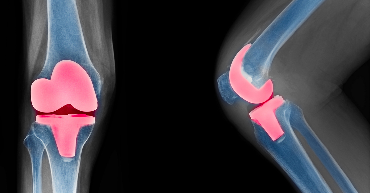 Autologous Chondrocyte Implantation Saves From Knee Replacement