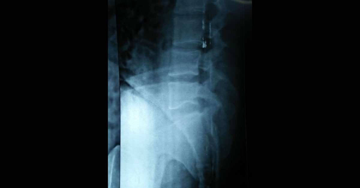 Is there a small round body in between L5 and S1
