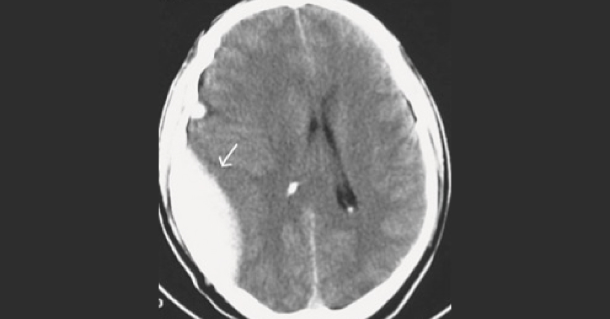 A Case Of Traumatic Head Injury