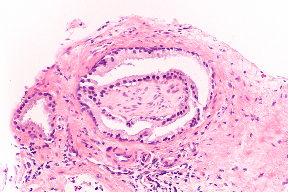 Sniff Urine Test Could Replace Prostatic Cancer Biopsies
