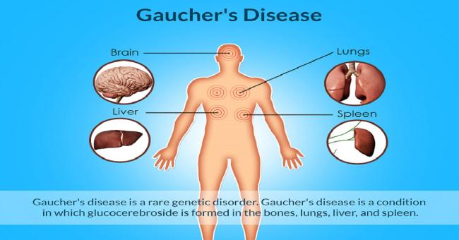 Eliglustat For Gaucher Disease
