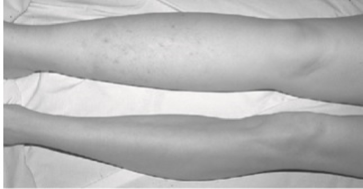 Diagnosis For Swollen Limb