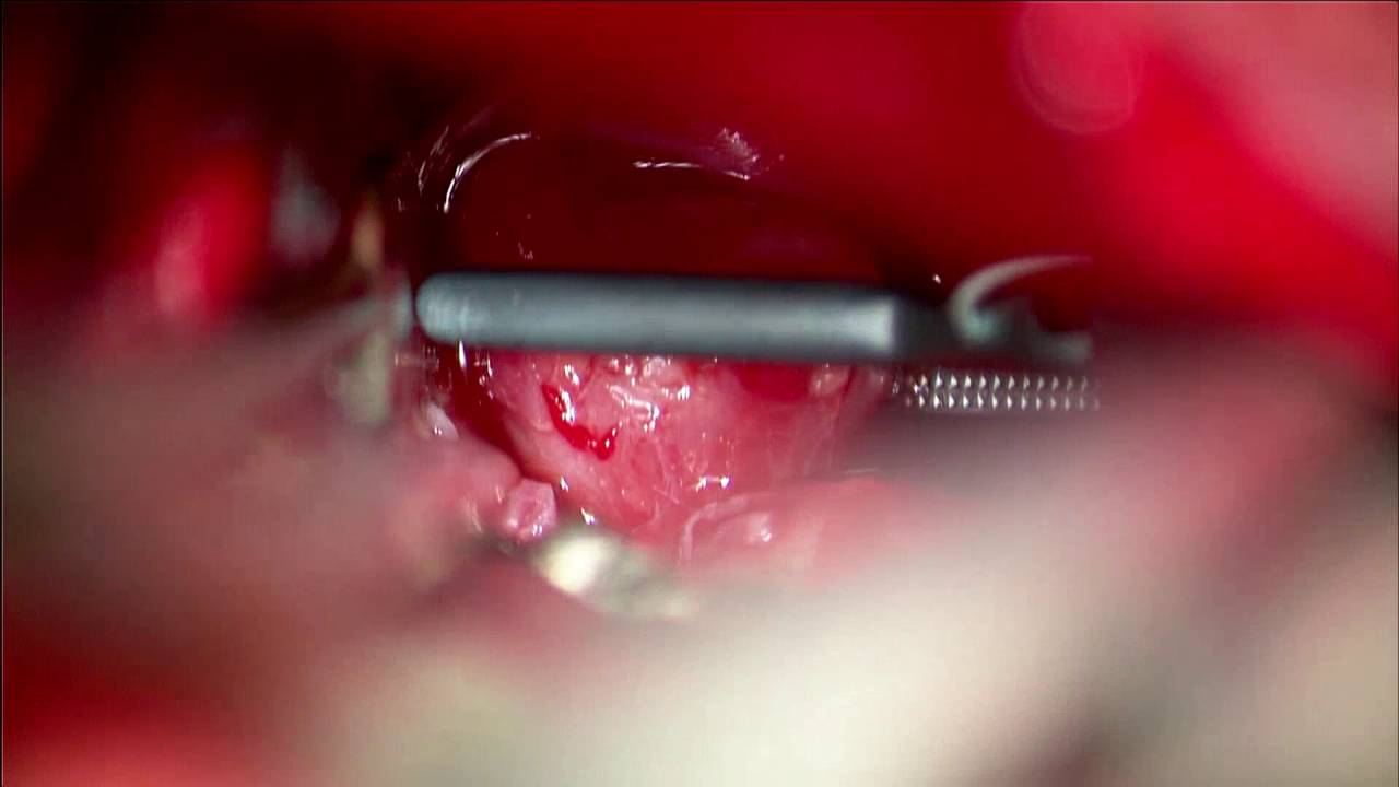 Intracranial Aneurysm Management by Supraorbital Minicraniotomy