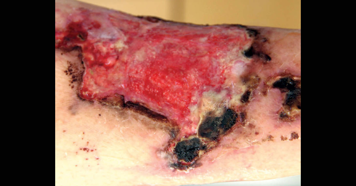 Cause Of Leg Ulcer