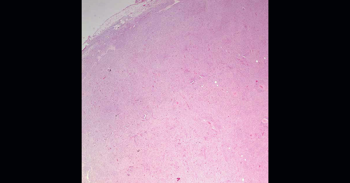 Man With High Fever, Fatigue And Weight Loss
