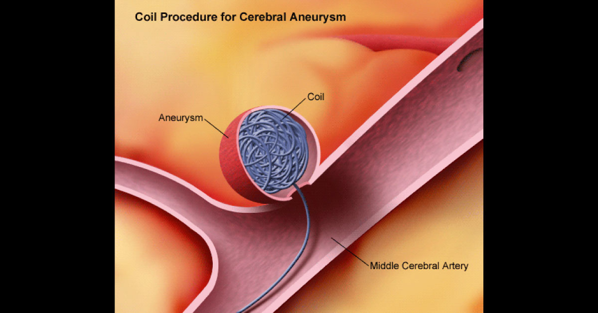 Coil Embolisation of Ruptured Intracranial Aneurysms