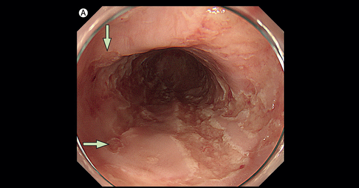 Esophageal Ulcers With The History Of Cord Blood Transfusion