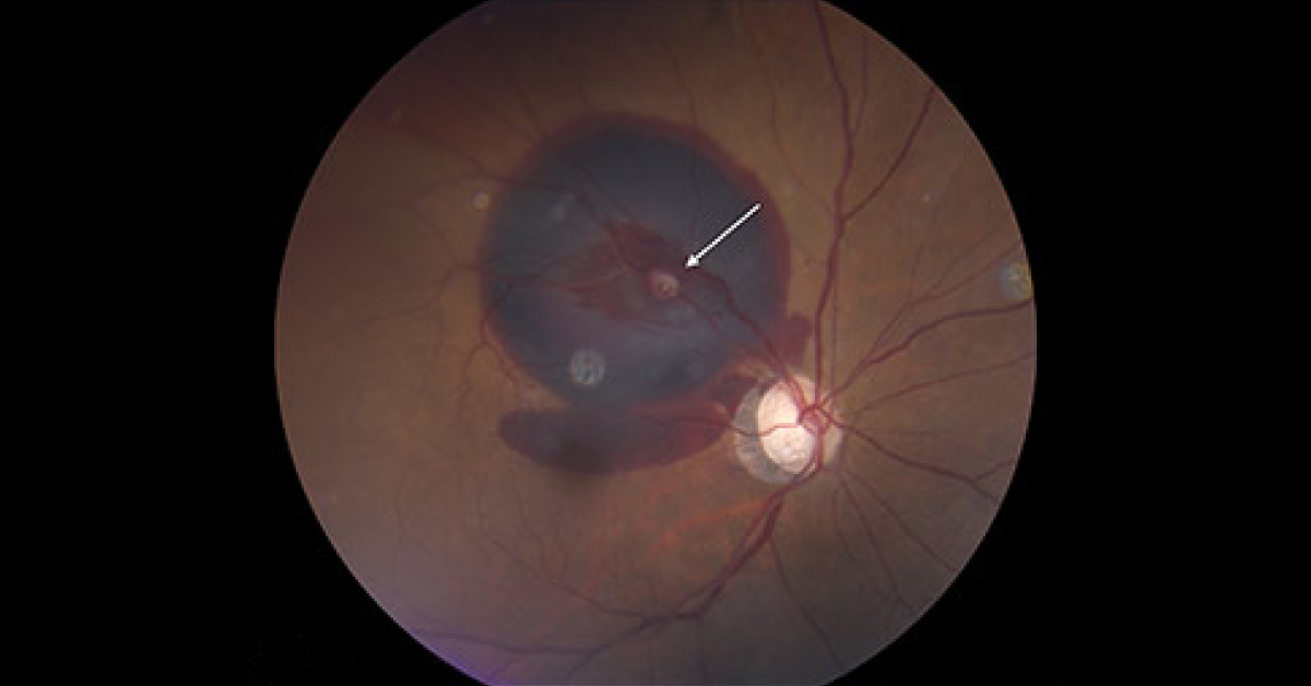 A Case Of Sudden Painless Vision Loss