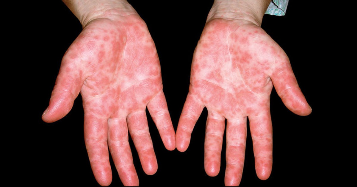What Is The Reason Of Rashes On Hand