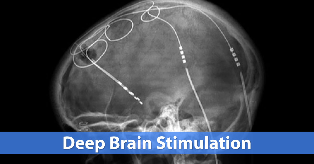 Deep Brain Stimulation For Tourettes Syndrome