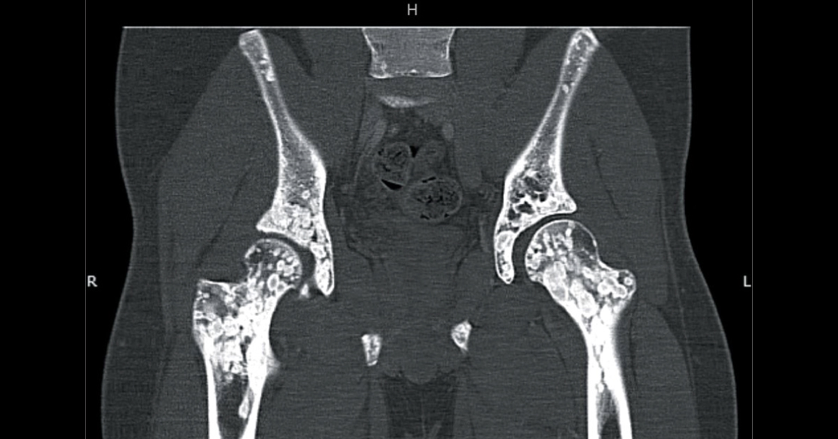 A Teenager With Ovoid, Radiodense Femur