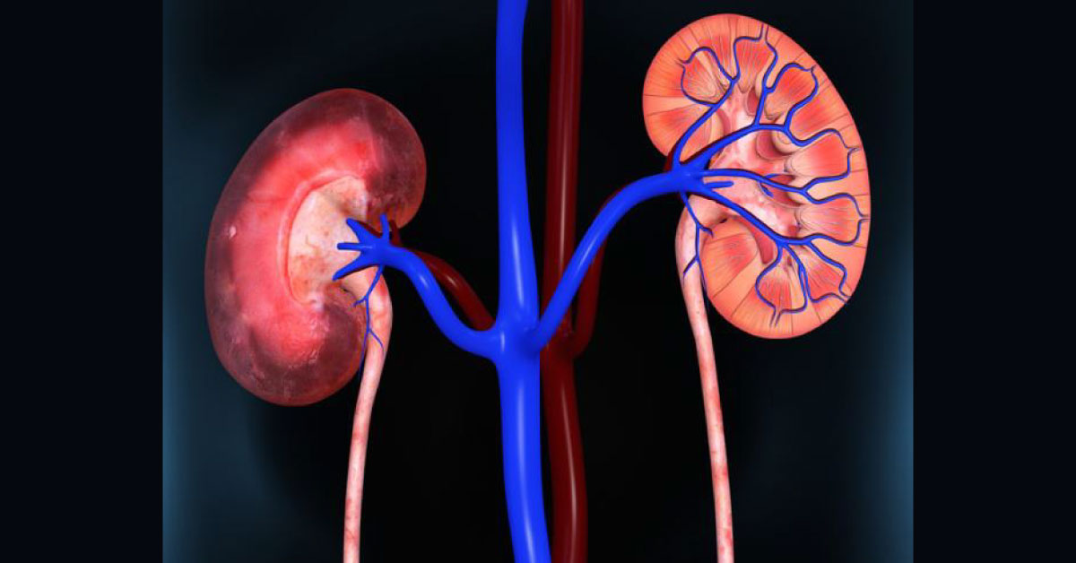 Lupus Nephritis, Aggressive Approach
