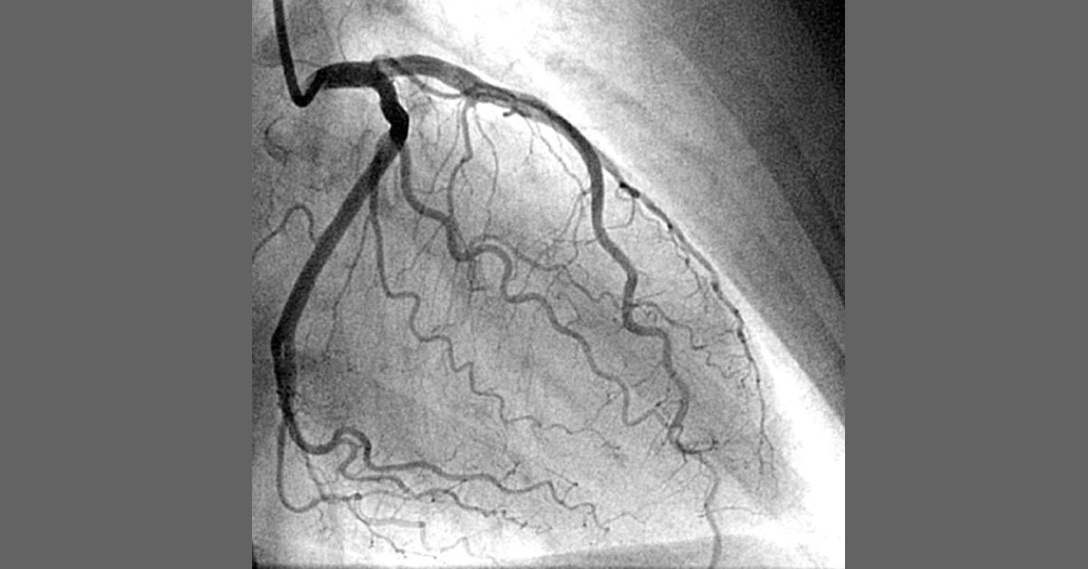 Coronary Angiogram