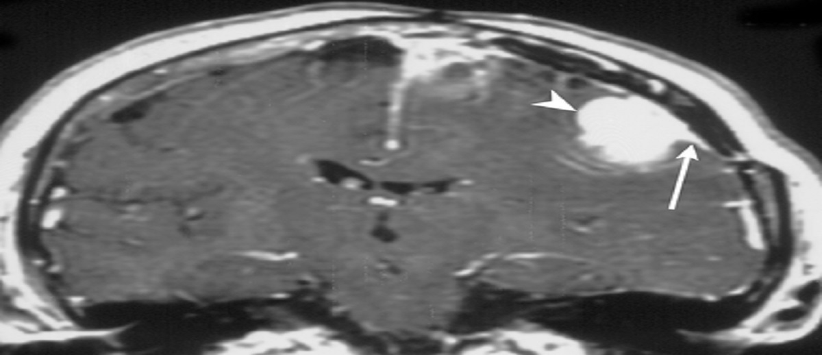 Dural Tail Sign, Pathology And Pathophysiology