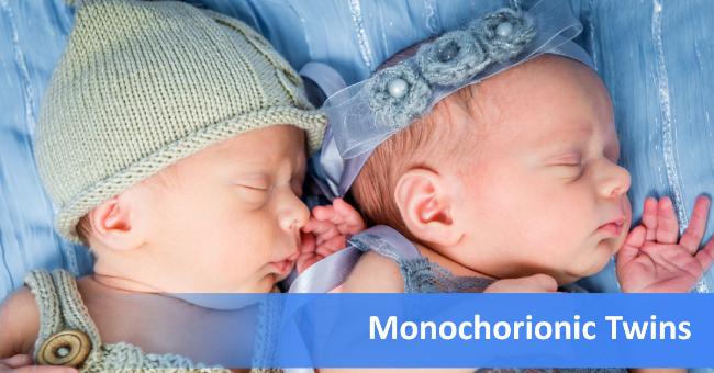 Monochorionic Twin Pregnancy Management: RCOG Guidelines