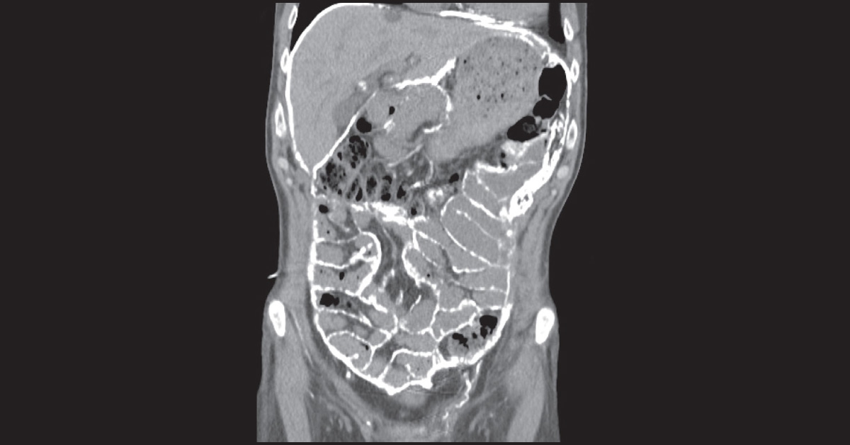 A Case Of Calcified Abdomen