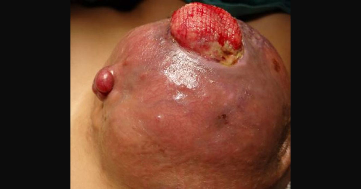 Fungating Growth In The Breast