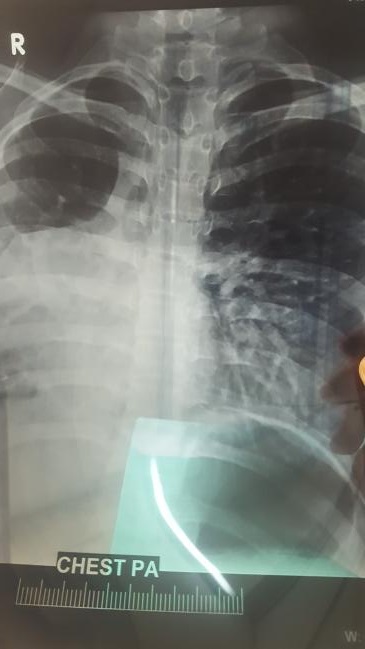 A Case Of Dextrocardia