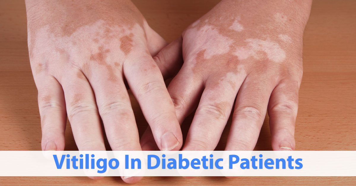 Vitiligo In Diabetes Patients