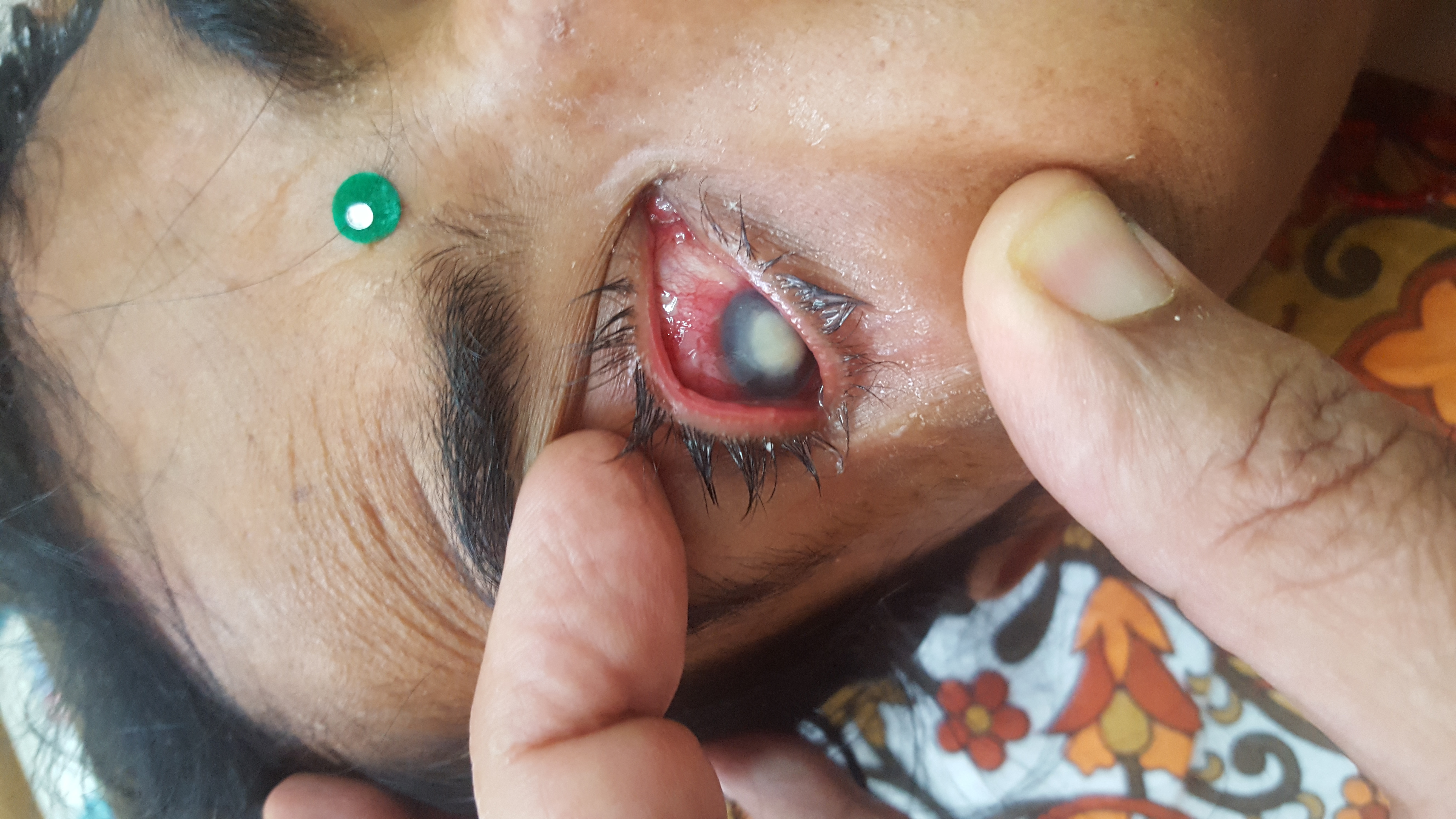 Can Eye Infection Cause Prolonged Fever