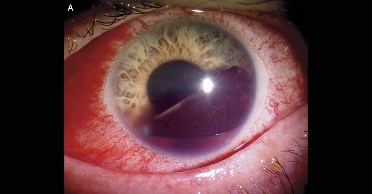 Identify The Cause Of Hyphema