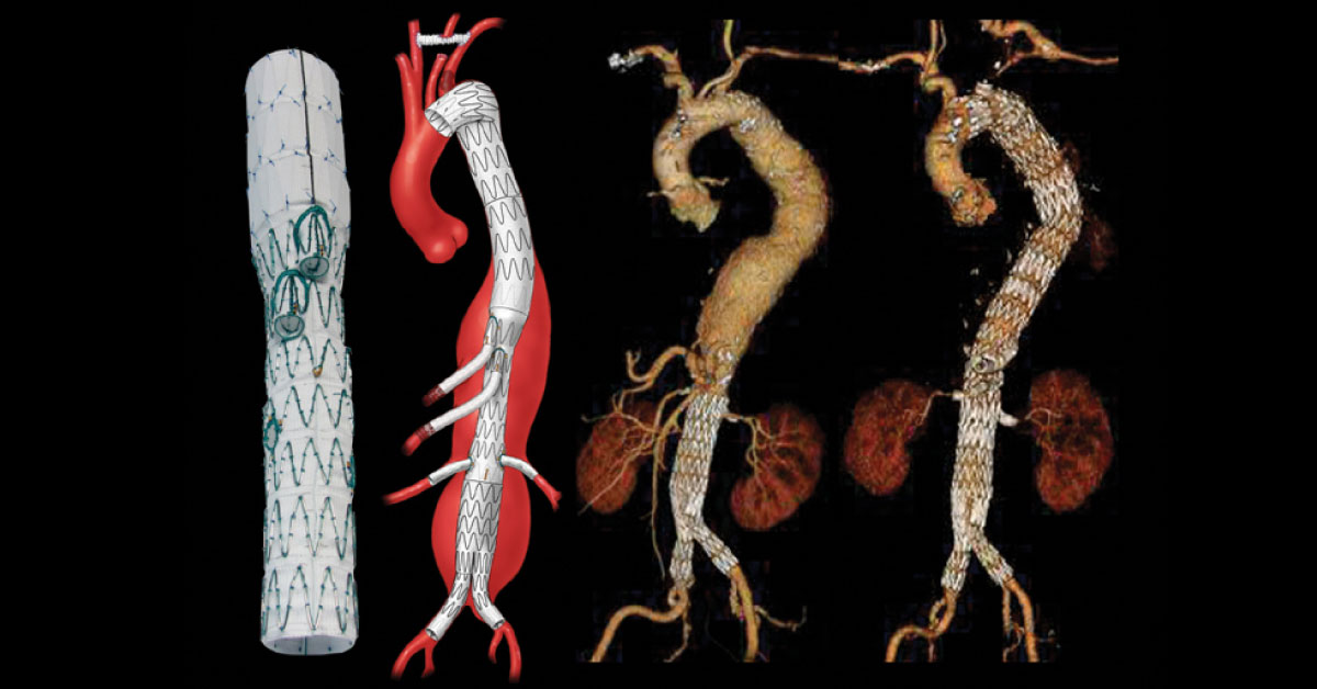 Placing Endovascular Stent Graft In Thoracic Aortic Aneurysms And Dissections