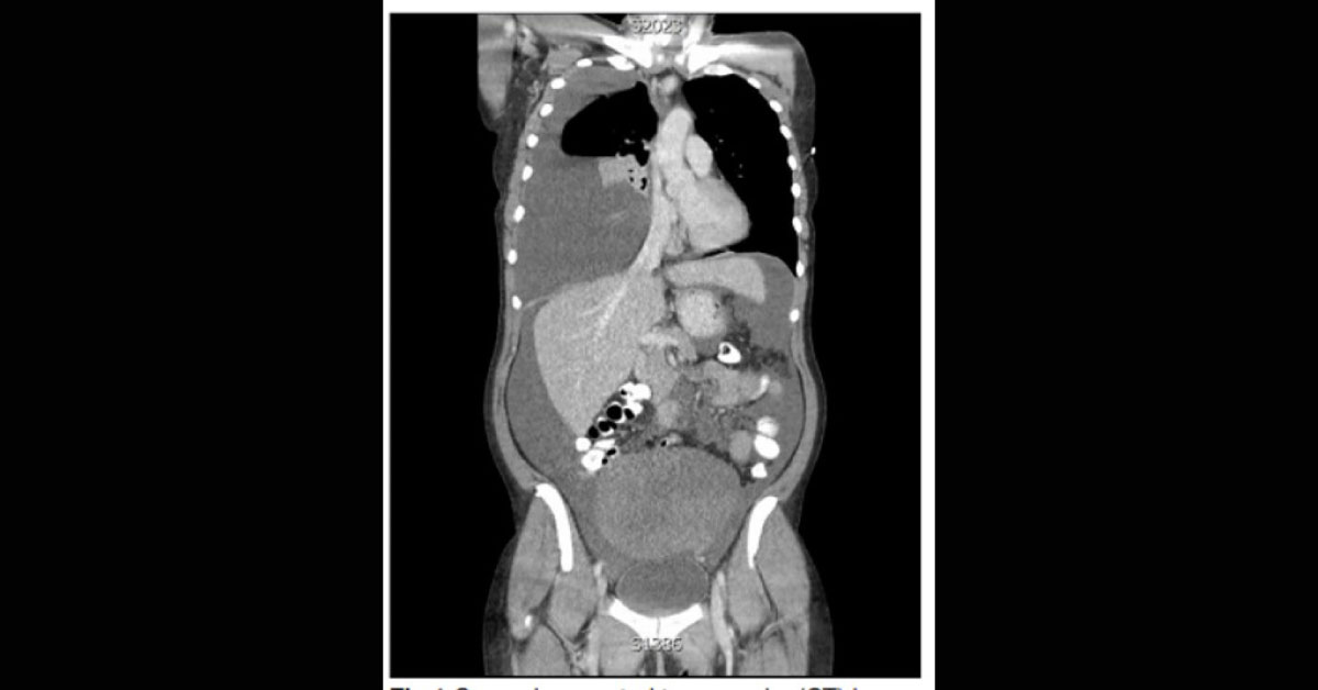 Breathlessness And Abdominal Swelling