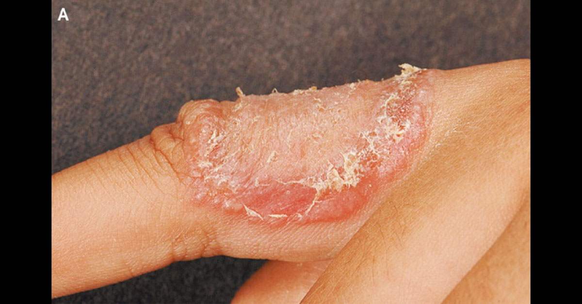 Blistering Eruption In A Pediatric Patient