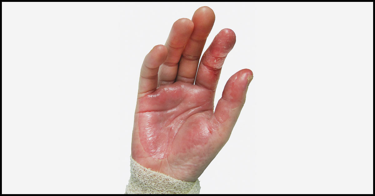 Palm Desquamation After Cesarean Surgery