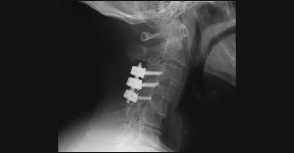 Cervical Spine Stabilization by Direct Lateral Mass Screw Procedure