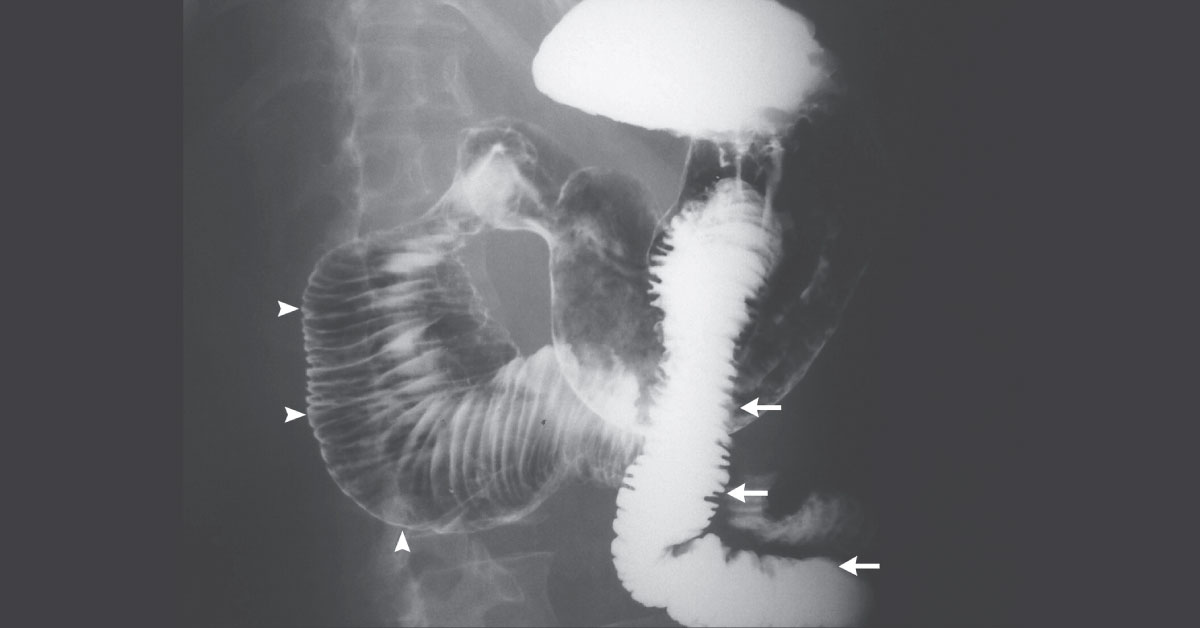 Distended Duodenum In A Systemic Sclerotic Woman