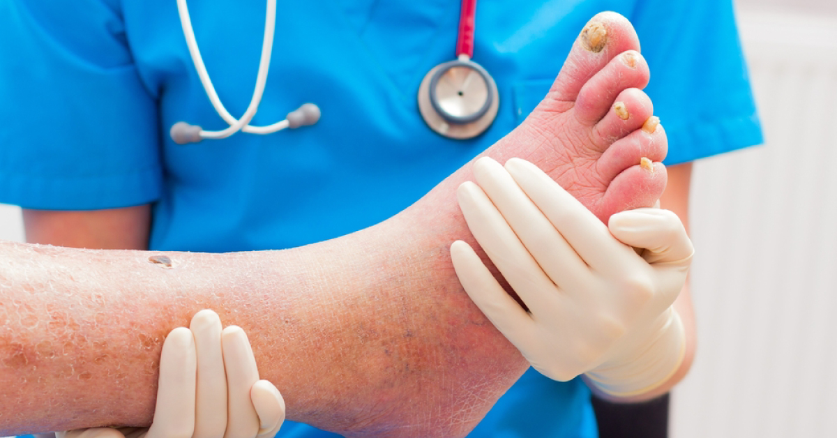 Serious Health Conditions Linked To Feet
