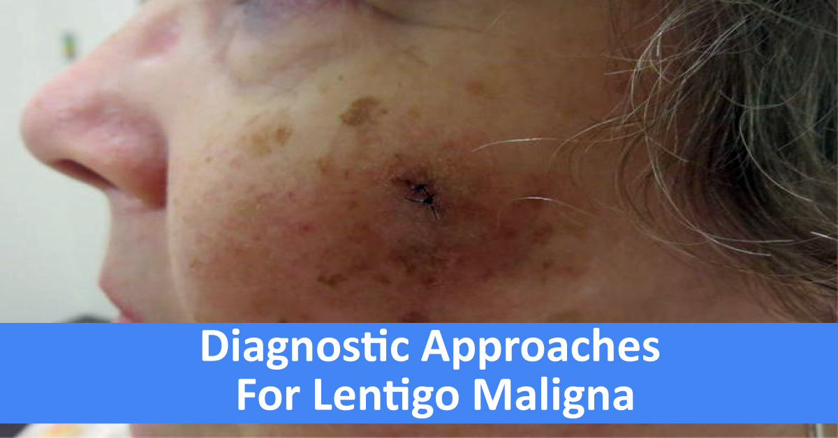 Diagnostic Approaches For Lentigo Maligna