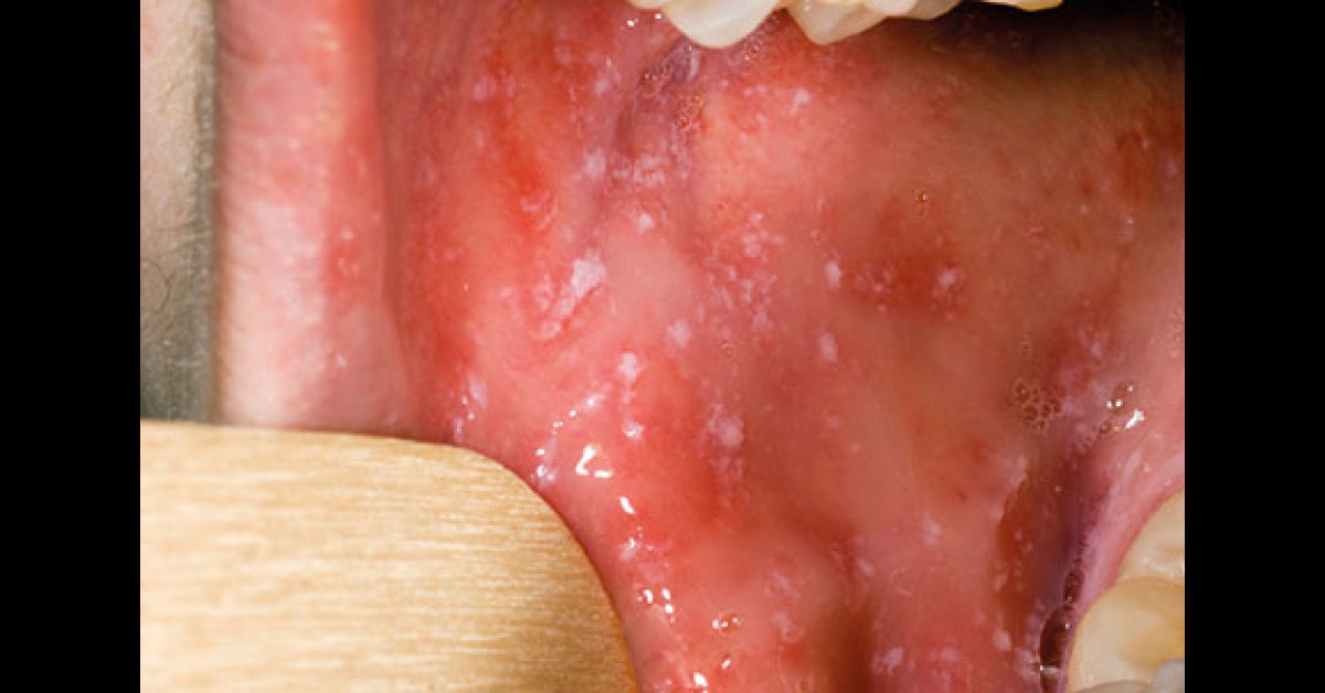 Diagnose The White Spots In Mouth