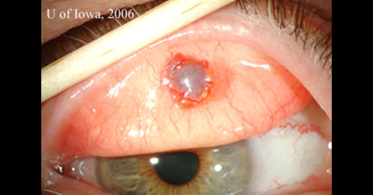 Identify The Rare Tumor