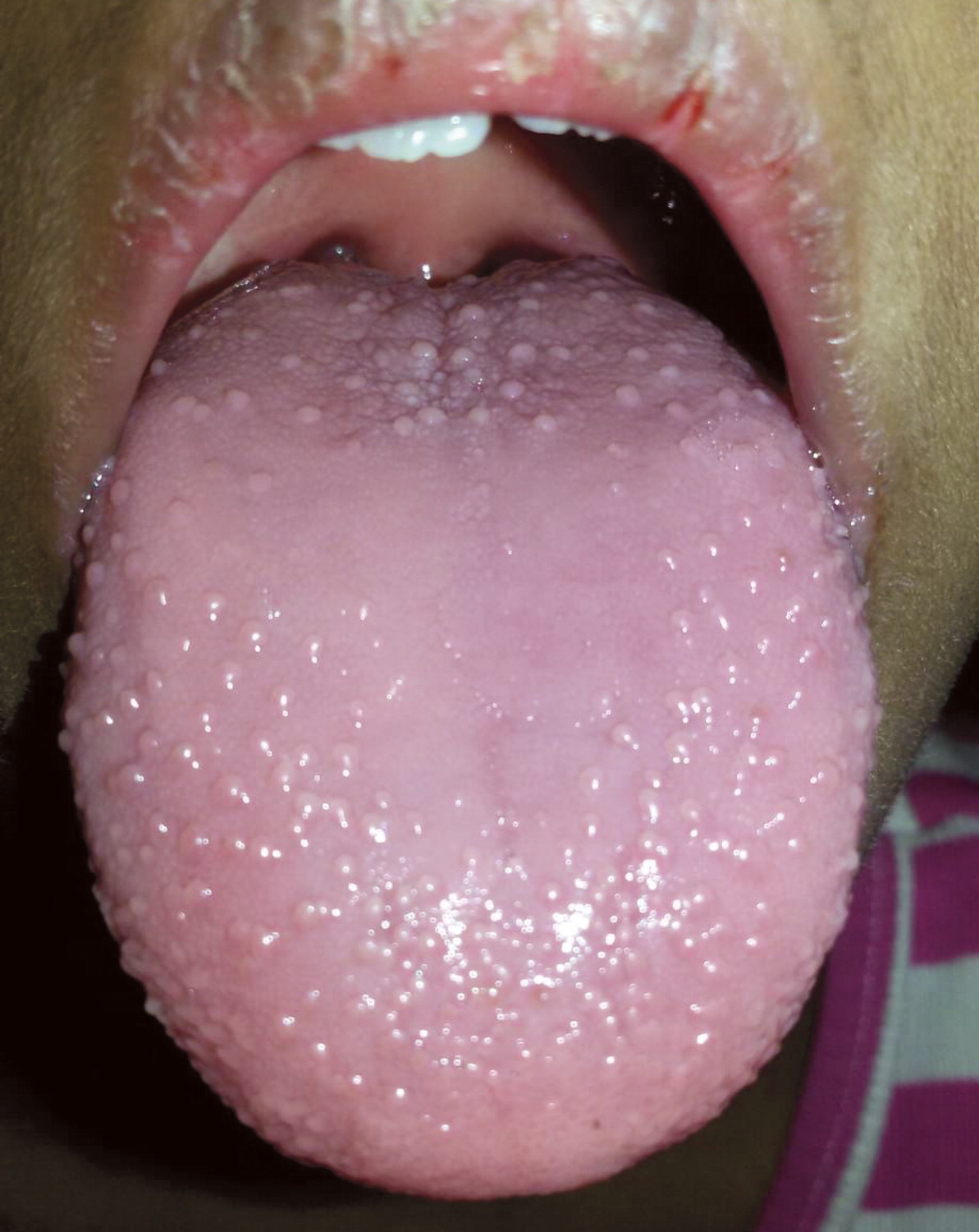 Strawberry Tongue In A Pediatric Patient