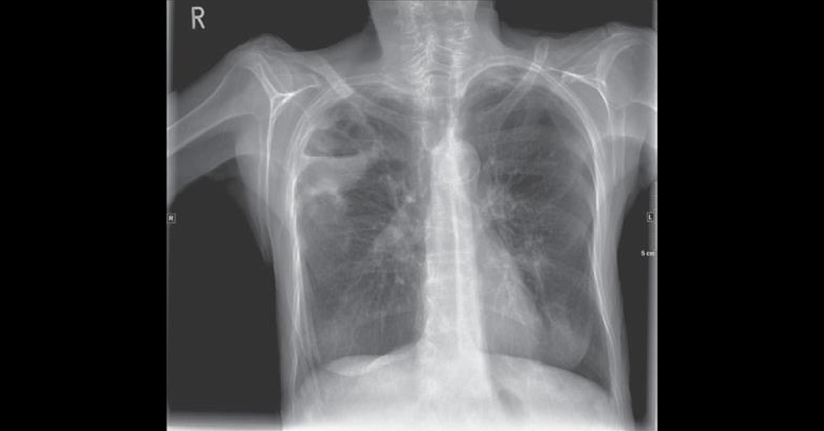 Chest Discomfort and Dyspnoea In A Male