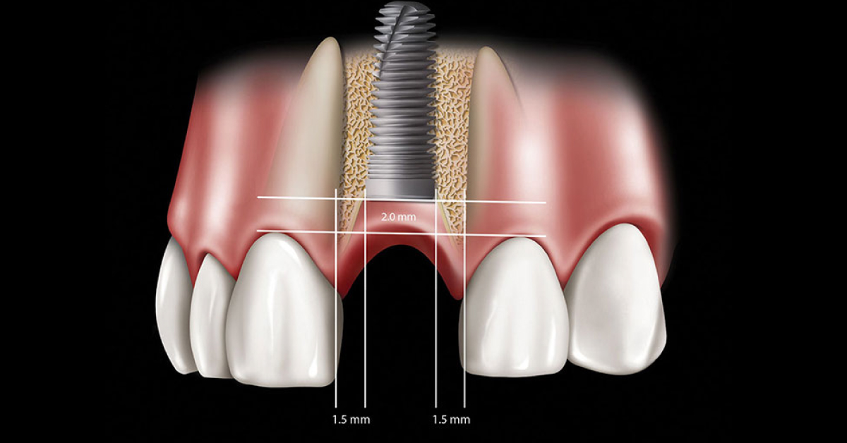 Peri Implant Crestal Bone Preservation