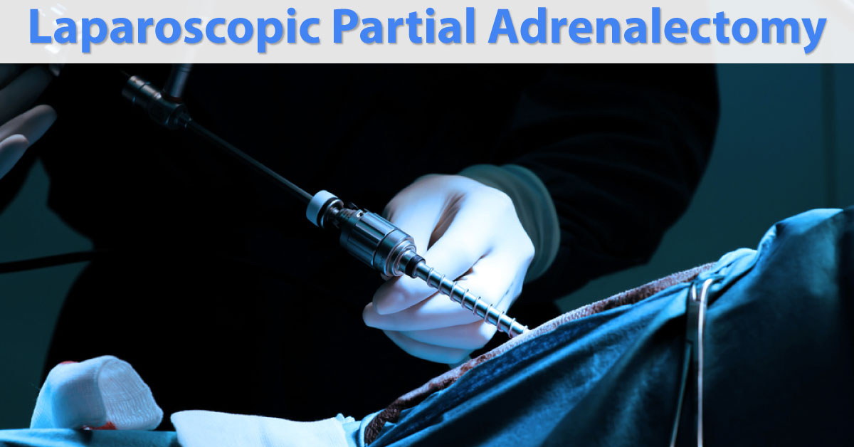 Recent Updates On Partial Adrenalectomy