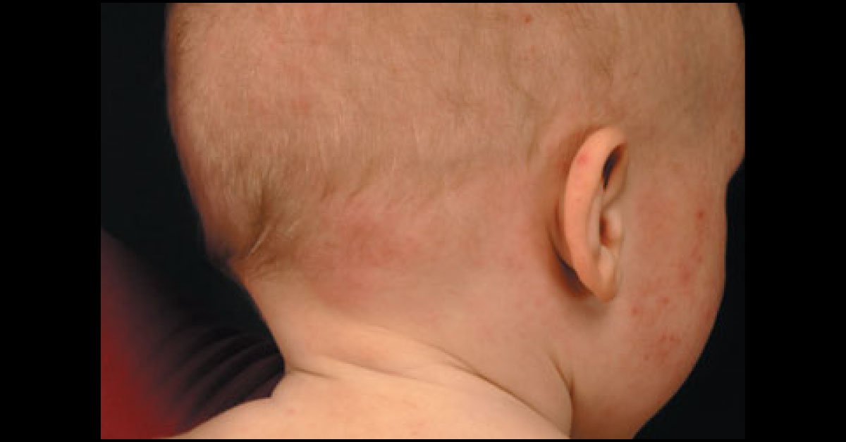 Diagnose The Itchy and Slow Growing Infant