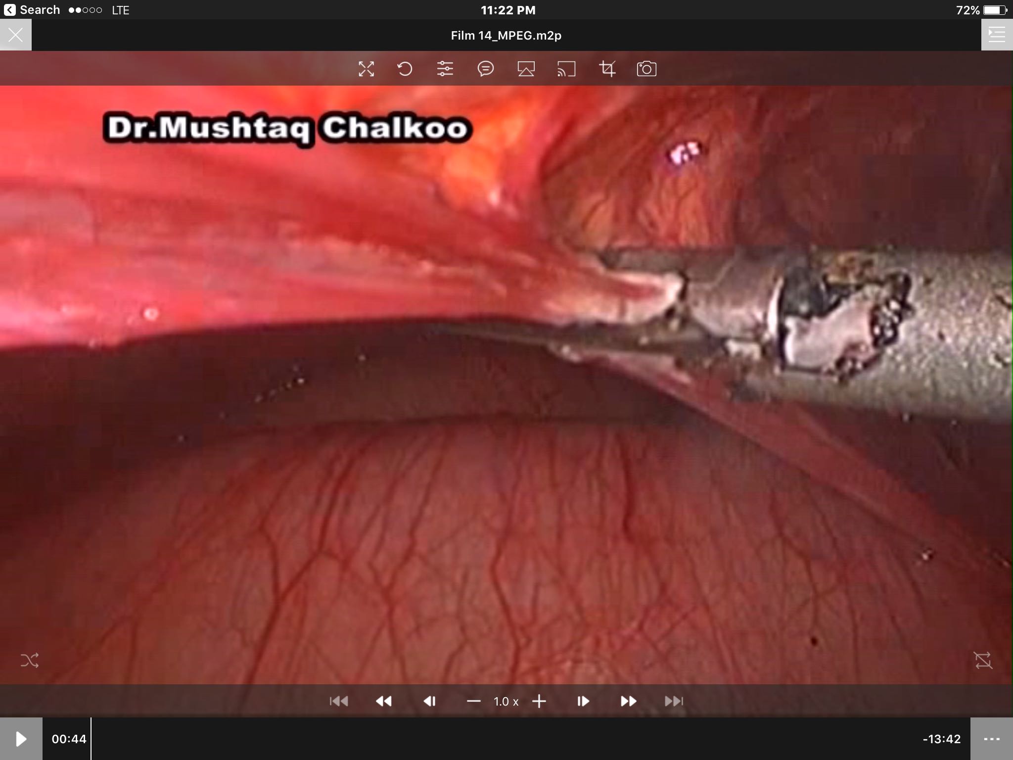 Laparoscopic Surgery For Meckel Diverticulum Presenting As Small Bowel Obstruction