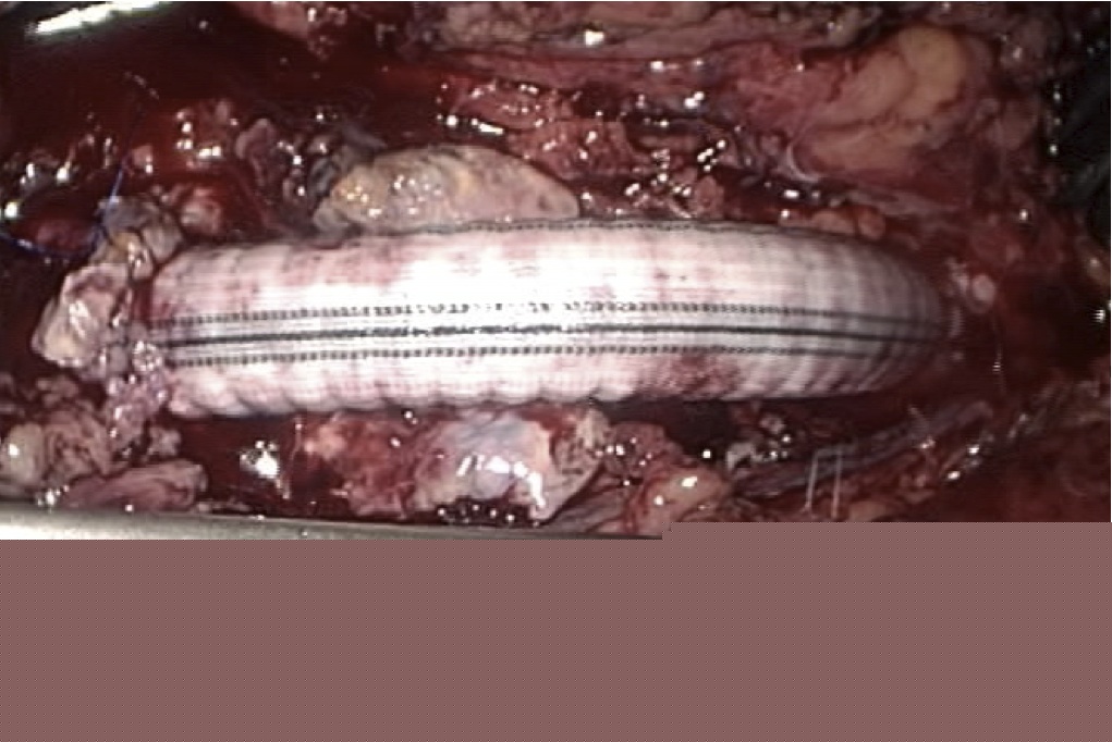 Abdominal Aortic Aneurysm by Laparoscopic Repair