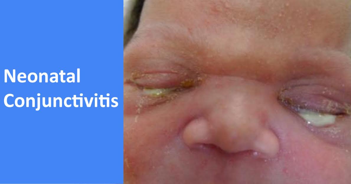 Neonatal Conjunctivitis, An Update