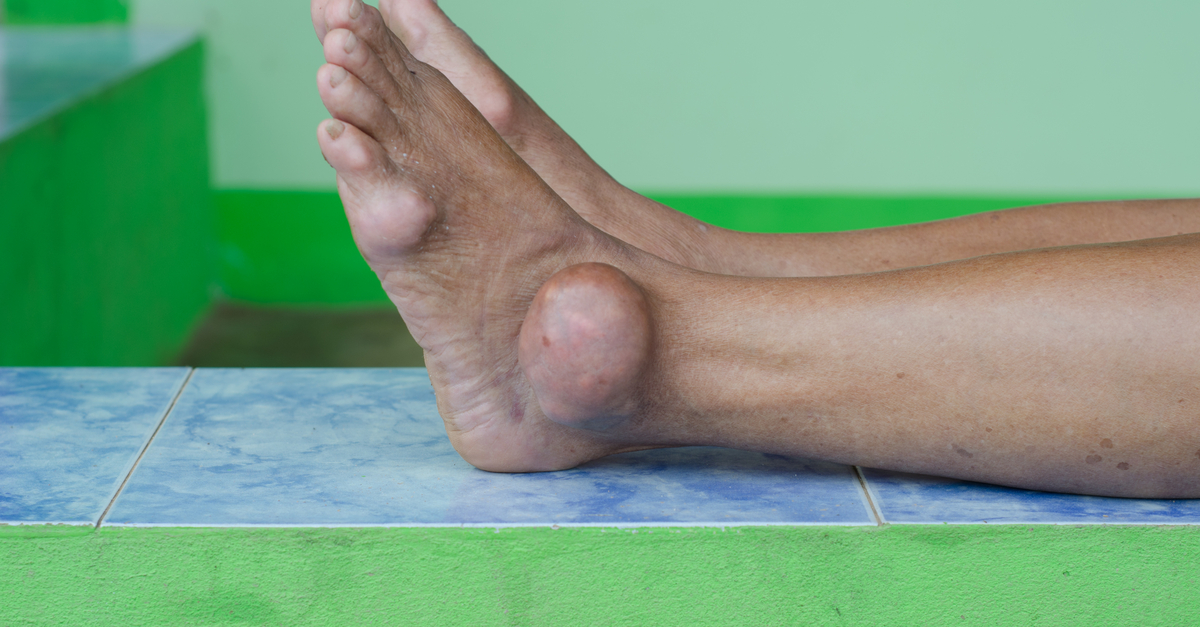Rheumatology Guideline for the Management of Gout