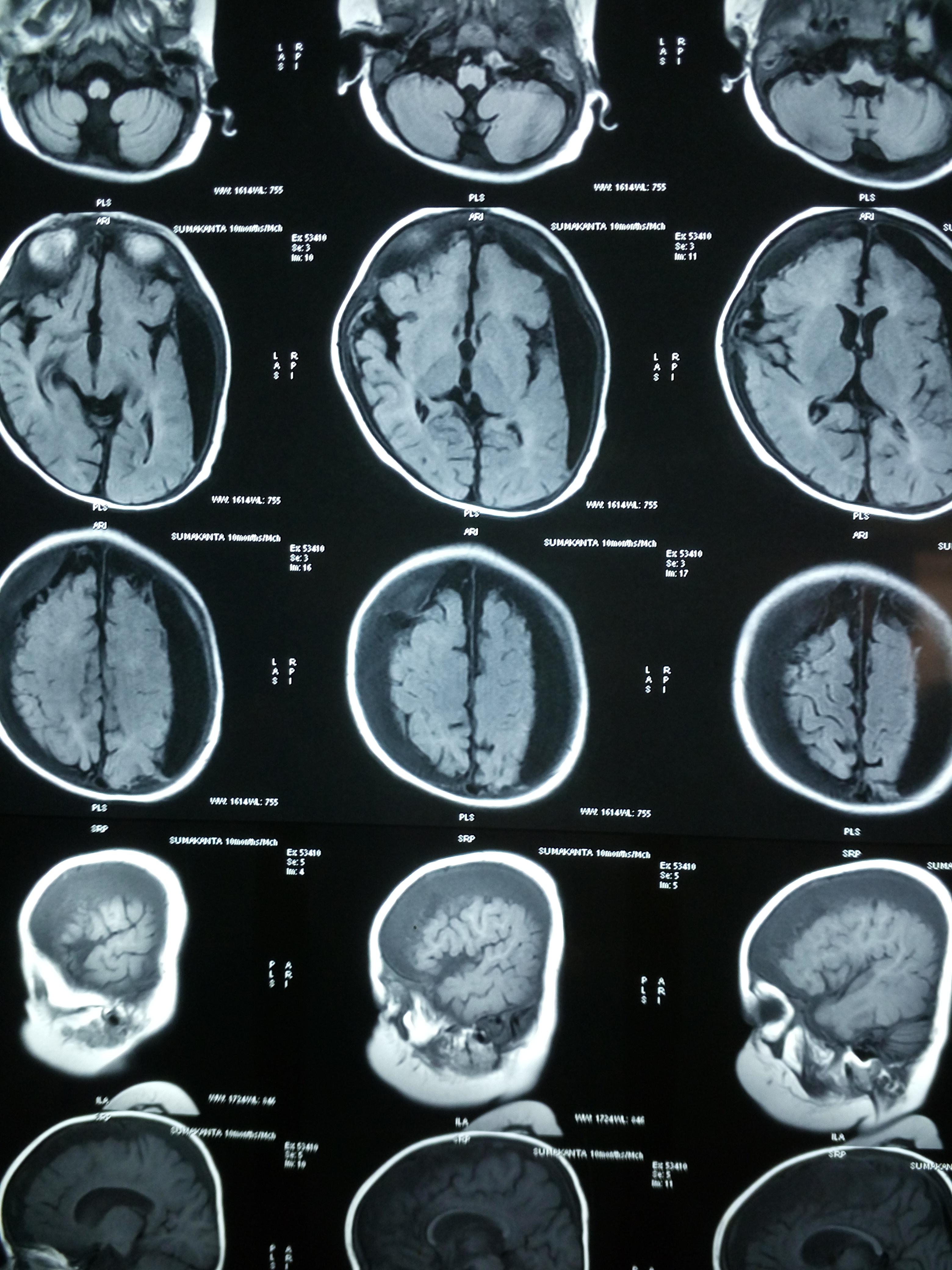Cause Of SDH In This Infant With Global Developmental Delay