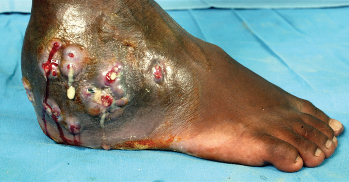 Mycetoma, Pathophysiology And Diagnostic Features