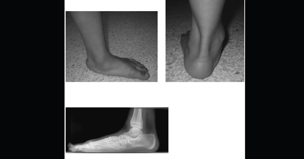 Flat Feet In Young Girl