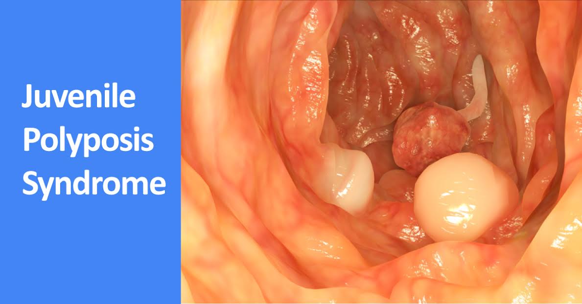 Juvenile Polyposis Syndrome, An autosomal dominant condition