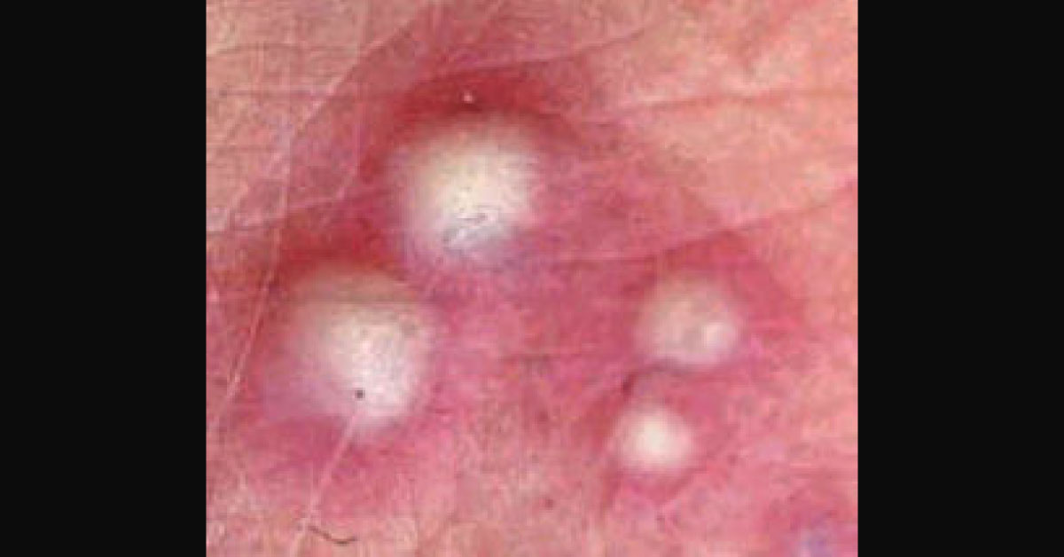 Spot The Dermal Condition From Image