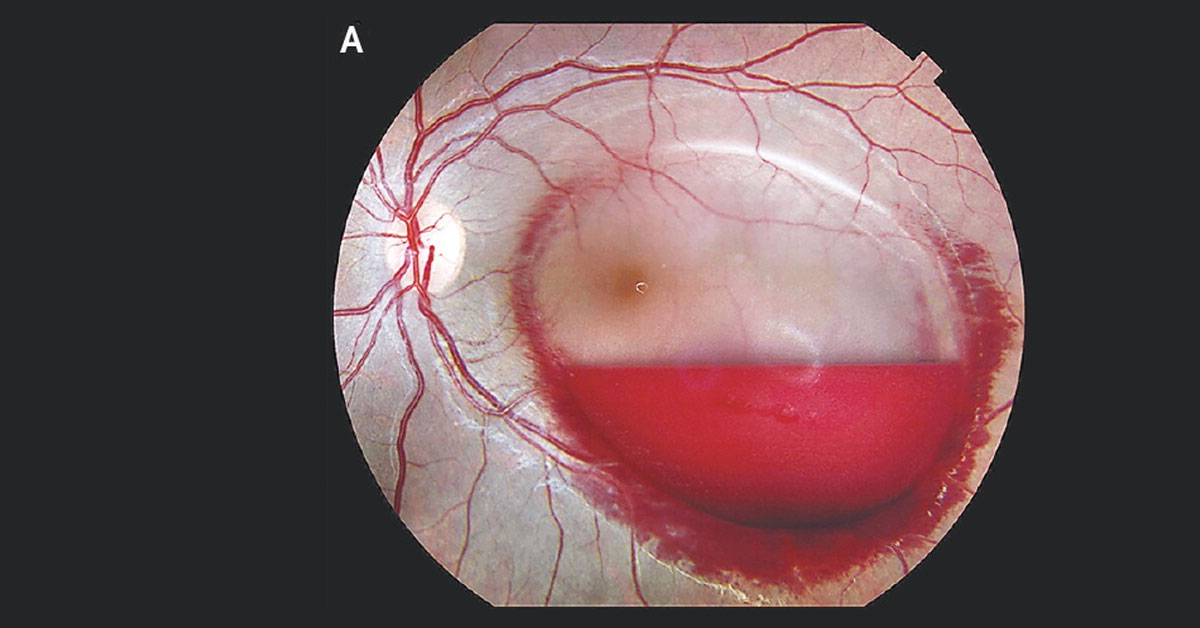 Self Resolving Hemorrhage In The Left Eye